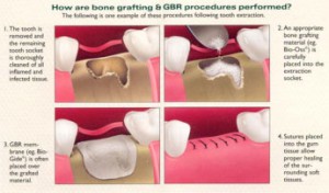 Bone Grafting | Gentle Dental Care