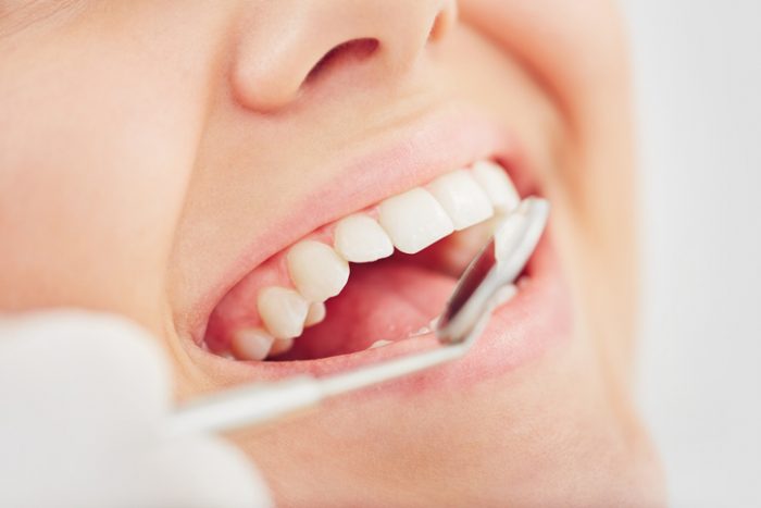 the-benefits-of-scale-and-polish-gentle-dental-care